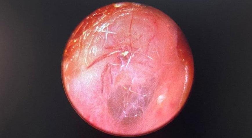 Kulağından canlı olarak çıktı! Hayatının şokunu yaşadı