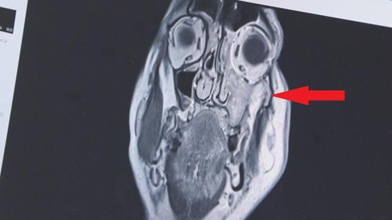 Sinüzit veya diş ağrısıyla karıştırılıyor, çok sinsi ilerliyor: 1 ay daha geç kalsaydı gözünü alacaktık