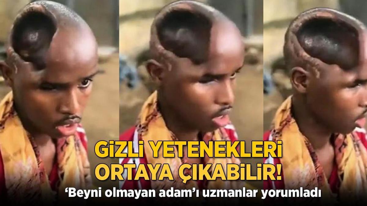 Gizli yetenekleri ortaya çıkabilir! ‘Beyni olmayan adam’ı uzmanlar yorumladı
