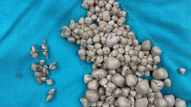 Akılalmaz olay! Böbreklerinden 300 taş çıkarıldı