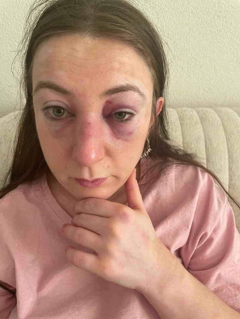 Yüzünü tanınmaz hale getirdi: Her kafa darbesine 1 yıl