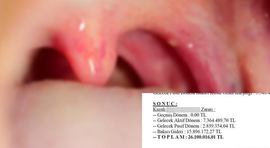 Bademcik ameliyatı sonrası engelli kaldı! 39 milyon liralık rekor tazminat talebi