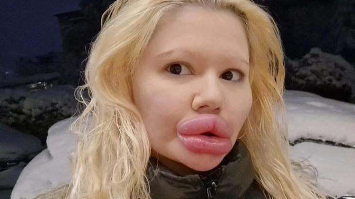 Tam 32 estetik operasyon geçirdi! ‘Hayati tehlikesi var ama genç görünmek istiyorum’