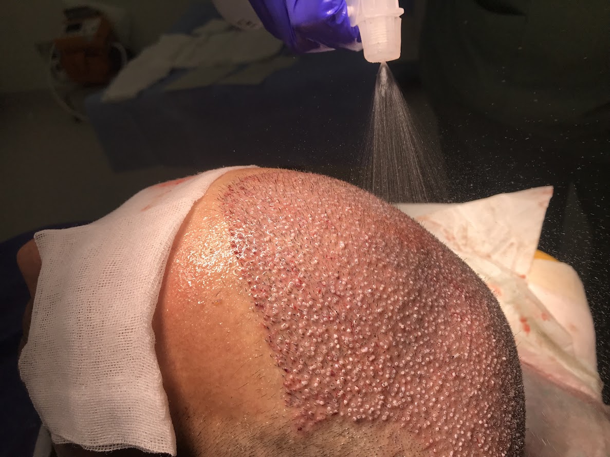 Clinista Saç Ekim Merkezi’nde Saç Ekimi: Hem Etkili Hem Doğal