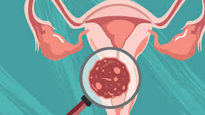 Rahim Ağzı Kanseri için Erkekler de Aşılanmalı