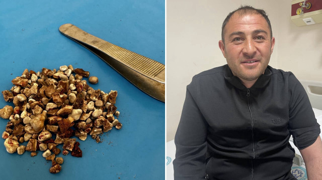 Karın Ağrısıyla Hastaneye Gitmişti! Böbreklerinden 300’den Fazla Taş Çıktı