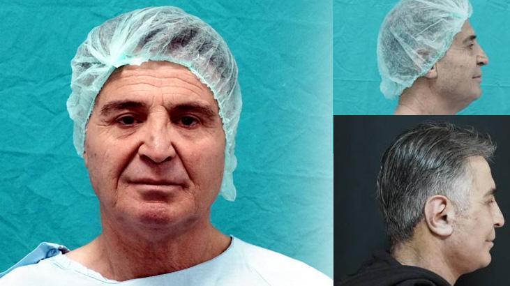 Bitlis’te Bir İlk: Derin Plan Yüz Germe Ameliyatı Başarıyla Gerçekleştirildi